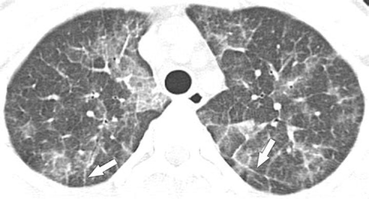 Did Leonard Bernstein Have AIDS? HIV And Lung Cancer