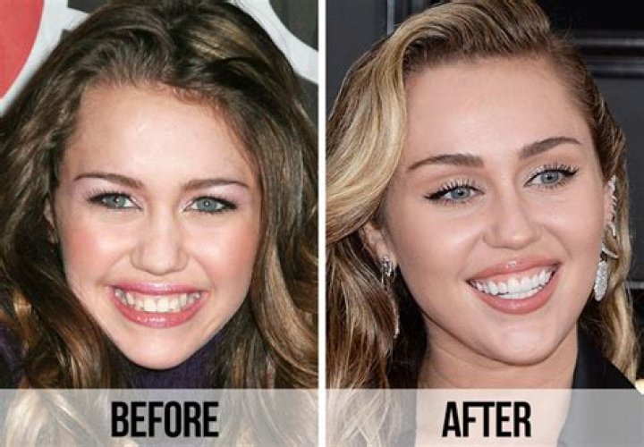 Does Miley Cyrus Have Fake Teeth? Here's What We Know