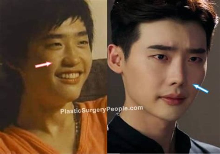How Does Lee Jong Suk Before Plastic Surgery?