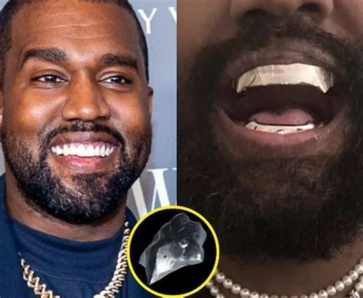 Kanye West Has New Metal Teeth Implants