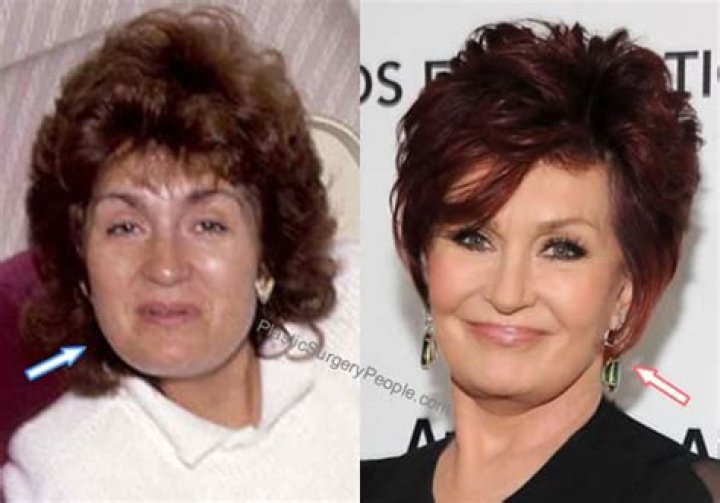 Check Out Sharon Osbourne Before and After Her Facelift: Pictures