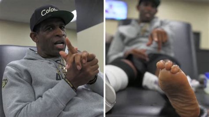 Deion Sanders Underwent Multiple Foot Surgeries, Faces Potential Foot Amputation