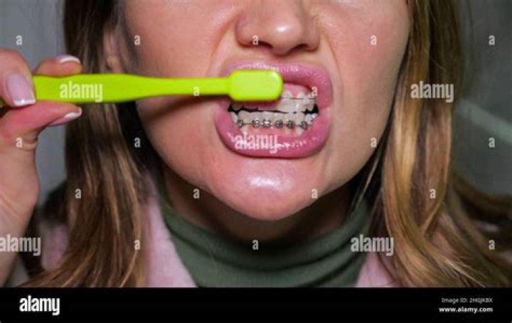 "It Looked Like a Toothpaste Tube" — Woman Accidentally Brushes Her Teeth with Icy Hot